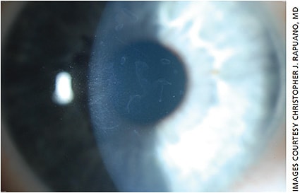 Figure 1. With use of a wide slit beam from the side, multiple areas of reduplicated basement membrane are seen centrally in this eye with epithelial basement membrane dystrophy.