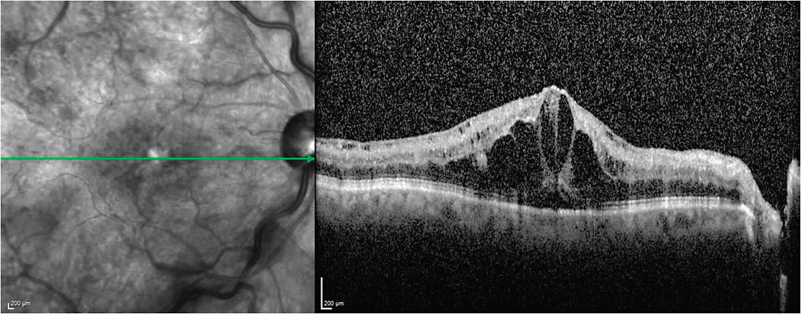 Figure 8. SD-OCT showing macular edema in a patient with central retinal vein occlusion.
