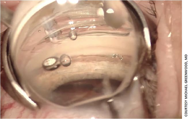 Figure 2. Hydrus implant (Ivantis).