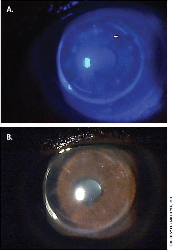 Figure 2. NK Stage 1. A 58-year-old after PKP for keratoconus who underwent a corneal astigmatic keratotomy. Both the PKP and the astigmatic keratotomy led to a surgically induced NK Stage 1.