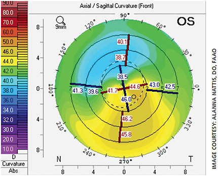 Figure 2. A topography image demonstrating post-LASIK ectasia.