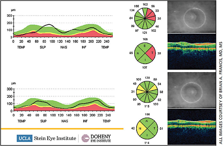 Figure 1. Centration error on OCT: This peripapillary RNFL scan shows a decentered scan in the top image with apparent focal thinning temporally (the part furthest away from the optic nerve head). When the scan circle is centered in the bottom image, this abnormality goes away (Zeiss Cirrus OCT).