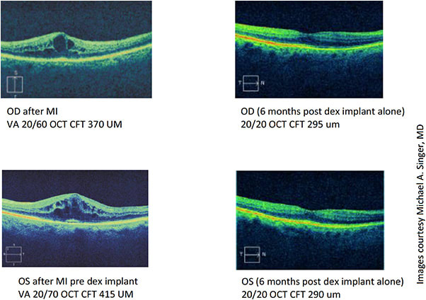 Figure 2: OCT readings from patient using Ozurdex, following cataract surgery and heart attack.