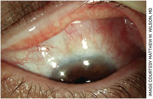 FIGURE 3. No clinical signs of residual PAM with atypia in the fornix.