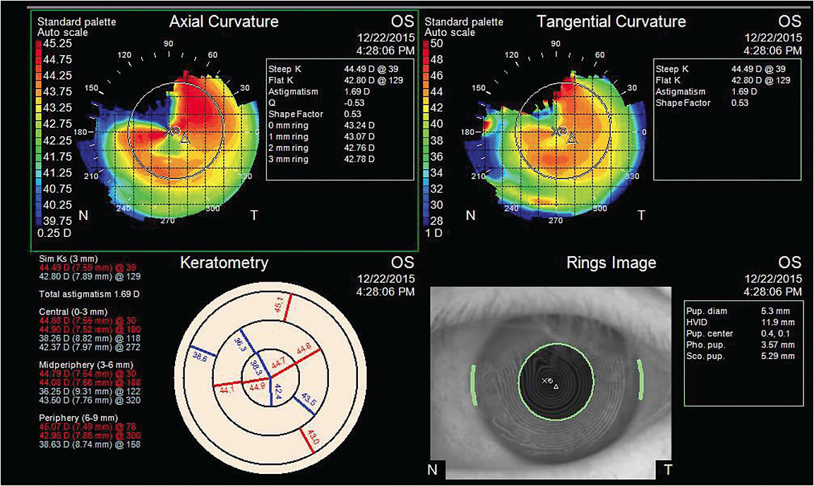 Figure 6B. The Placido rings in the lower right image are distorted, and the color maps demonstrate significant irregular astigmatism in the eye with a Salzmann’s nodule seen in Figure 6A.