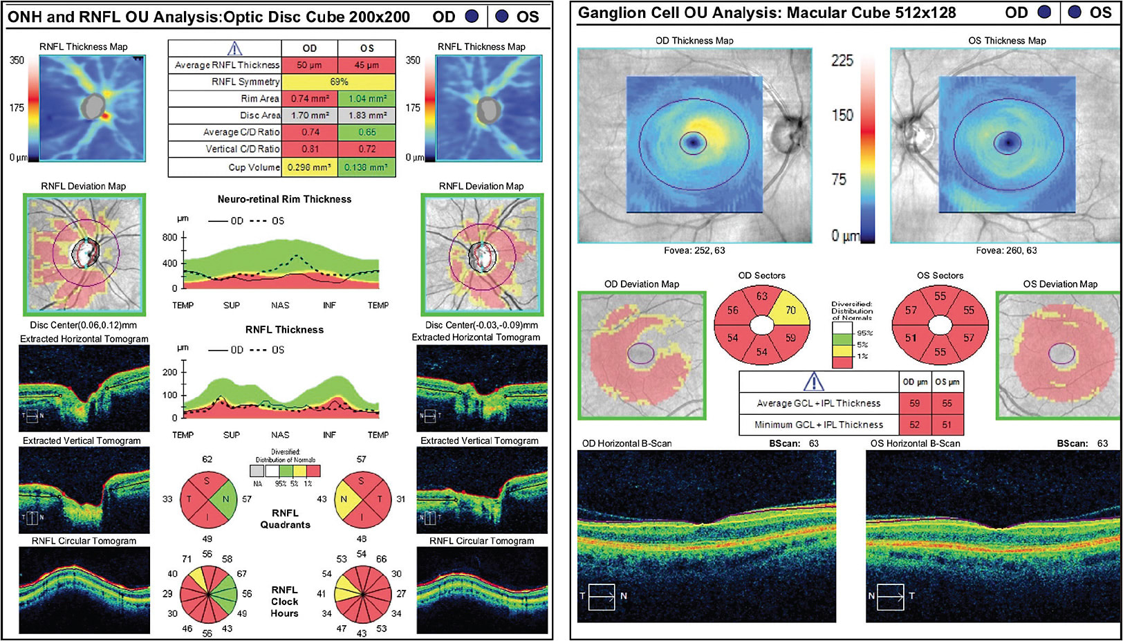 Figure 3. “Floor” effect: On the left, OCT shows a patient with advanced glaucomatous optic nerve damage with a very thin RNFL who may not show progressive thinning from this point on. The macula OCT on the right shows the ganglion cell complex of the macula, which may still be useful to detect progression in this same advanced patient (Zeiss Cirrus OCT).