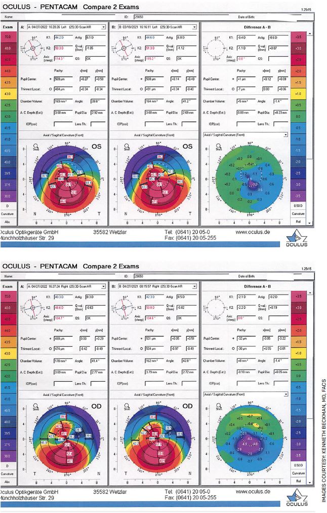 FIGURE. A 25-year-old female with moderate keratoconus who underwent corneal crosslinking (CXL) in each eye approximately 1 year ago