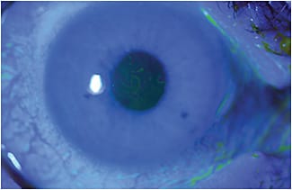 Figure 3B. Fluorescein dye with the cobalt blue light highlights the negative staining caused by the elevated central epithelial basement membrane dystrophy lesions in the eye seen in Figure 3A.