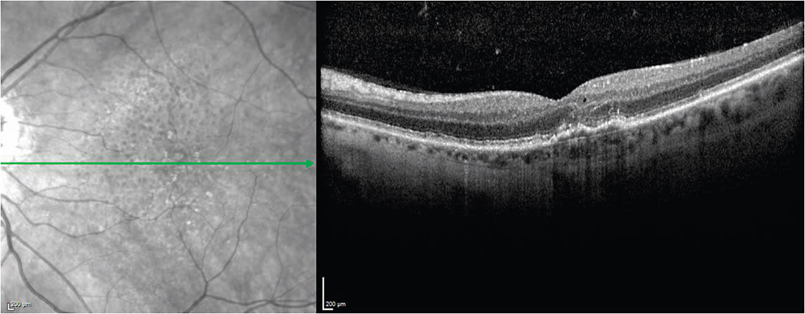 Figure 4. SD-OCT showing irregularity of outer retinal/photoreceptor layer and elevation of RPE with trace intraretinal fluid.