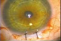 Temporary silk sutures assist in maintaining the chamber depth during enclavation. (Image courtesy of John Hunkeler, M.D.)