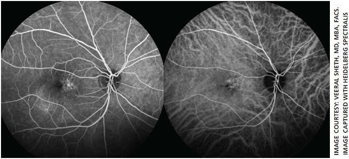 Figure 3. En face OCT image demonstrating initial retinal thickening prior to treatment with micropulse laser.