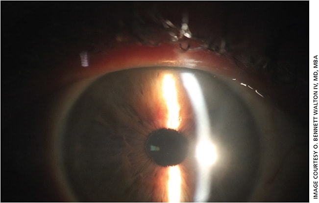 The view through a LASIK flap of an extended-depth-of-focus lens in a patient’s eye.