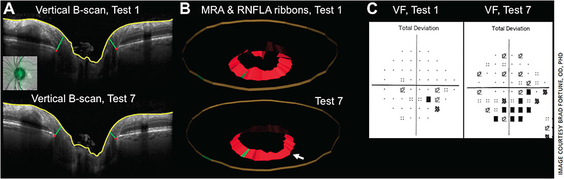 Figure 1. An example of glaucoma progression in an individual eye as determined by standard visual fields and by measuring the optic nerve head (ONH) neural rim tissue parameters minimum rim width (MRW) and minimum rim area (MRA) every six months. 
(A) B-scan through the vertical meridian of the ONH at Test 1 (top) and Test 7 (3.5 years later, bottom). The inset shows the B-scan location indicated by the bold green line overlaid onto the SLO infrared reflectance image. Structures delineated in each radial B-scan include the internal limiting membrane (ILM, yellow) and Bruch’s membrane opening (BMO) points (red). The green segments connecting BMO points to the ILM represent the minimum distance from each BMO point to the ILM, that is, the MRW. 
(B) Derivation of MRA from the 48 radial trapezoidal sectors of each delineated ONH scan. The MRA is shown as a red, ribbon-like structure at Test 1 (top) and Test 7 (bottom); note thinner MRA at Test 7, particularly along the superior and superotemporal sector (arrow). The green-colored MRA sector is temporal location. The circumpapillary retinal nerve fiber layer thickness is represented in each panel by the gold colored ribbon. 
(C) Standard automated perimetry visual field total deviation probability plots show inferior Bjerrum scotoma at Test 1 evolving into a wider, deeper arcuate scotoma at Test 7.