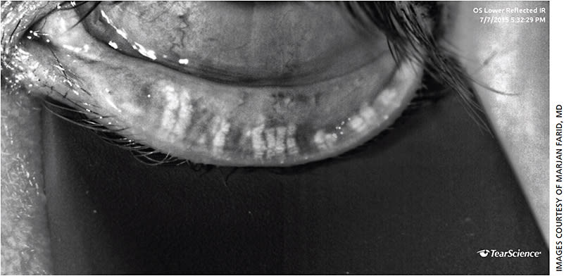 Figure 1. Meibography image of a patient with significant shortening and dropout of the meibomian glands.