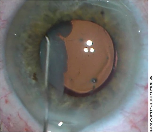 Figure 1. An intravitreal injection of ImprimisRx’s Tri-Moxic triamcinolone acetonide-moxifloxacin.