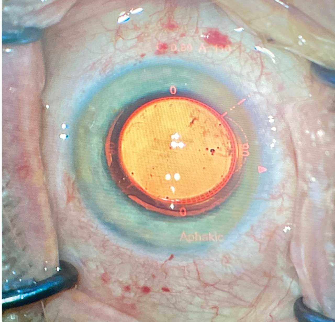 ORA reticle being used to align a toric lens