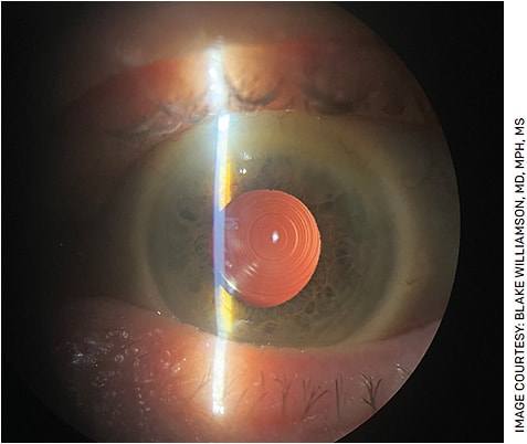 Slit lamp photo of a day one postop Synergy CLR patient
