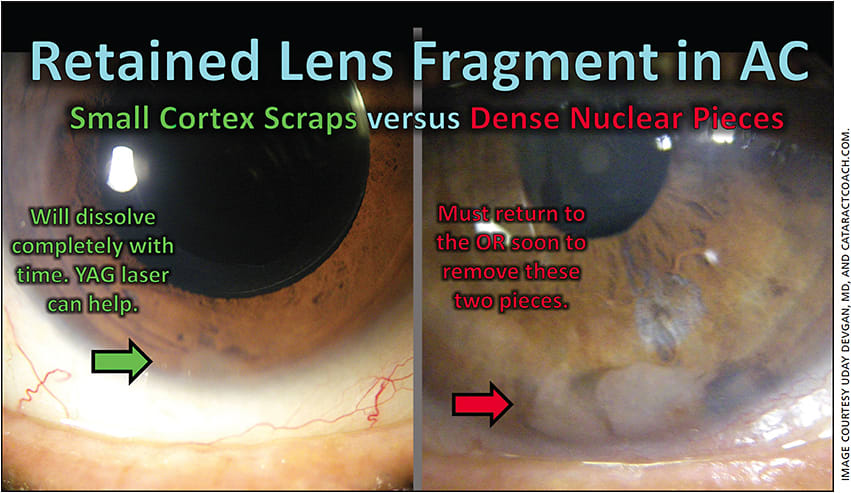 Figure 3. A small piece of fluffy cortex (left) will tend to dissolve within a week or two, while dense nuclear pieces (right) will not and should be removed with a return trip to the operating room.