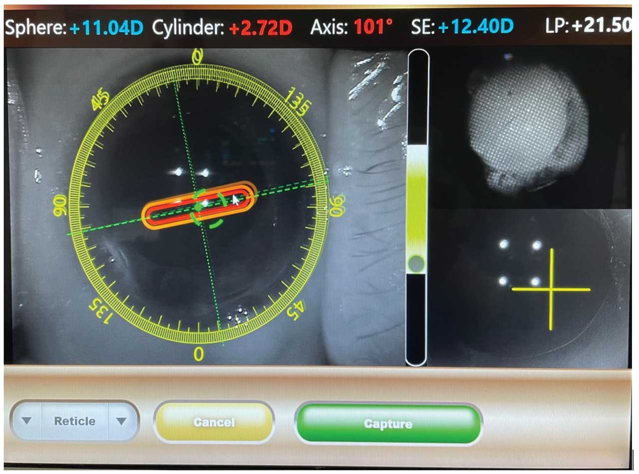 ORA being used intraoperatively to measure sphere and cylinder refractive errors