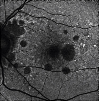 Figure 3. Fundus autofluorescence showing areas of macular and peripapillary RPE loss in a patient with AMD.