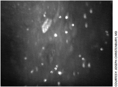 Figure 1. Confocal microscopy image of Acanthamoeba ulcer showing hyperreflective cysts.