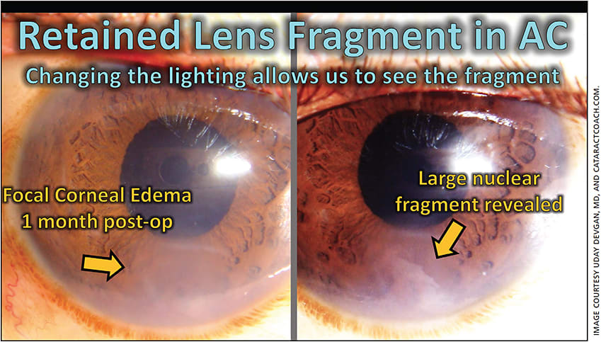 Figure 1. Focal corneal edema (left), which blocked the view of the retained lens fragment until an adjustment in the lighting revealed a large nuclear piece at the inferior angle (right).