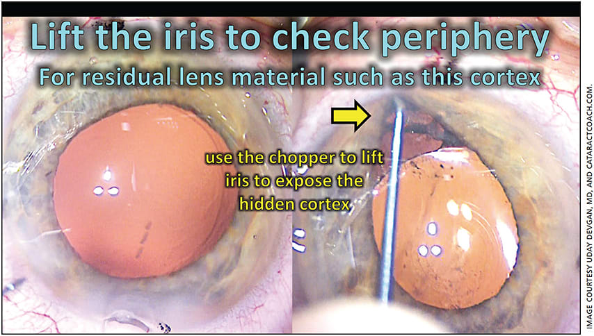 Figure 2. The chopper is used to lift the iris to expose the hidden cortex, which must be removed.