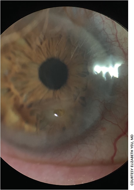Figure 4. Stage 3 NK. Peripheral neovascularization nasally and a diffuse anterior stromal scar inferonasally, spanning the mid-periphery from 3 to 6 o’clock.
