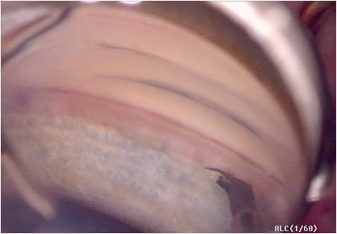 Intraoperative photo of the Kahook Dual Blade. Note the pointed tip, which will allow penetration and stretching of the trabecular meshwork. The blades are located on either side of the tip, allowing it to cut the meshwork.