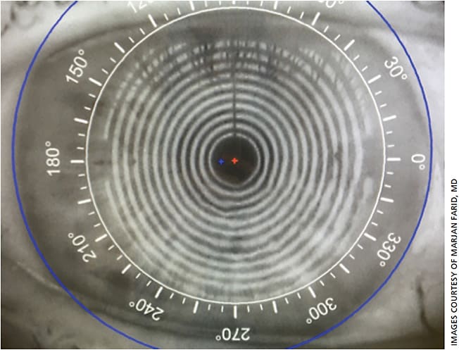 Figure 2. Preoperative topography image shows irregular mires from poor tear film and DED.