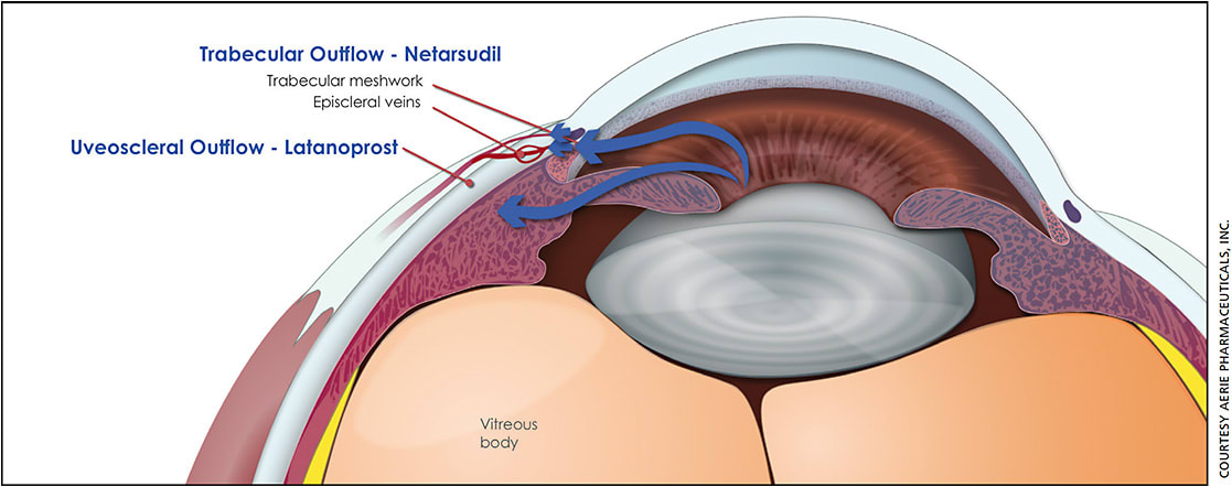 Rocklatan combines the mechanisms of action of netarsudil and latanoprost, increasing outflow through both the trabecular (conventional) and uveoscleral pathways, in a single, once-daily drop.