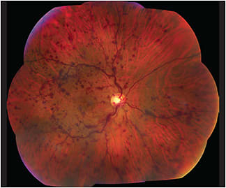 Figure 6. Color fundus photo showing multiple dot-blot hemorrhages in a patient with a central retinal vein occlusion in the right eye.