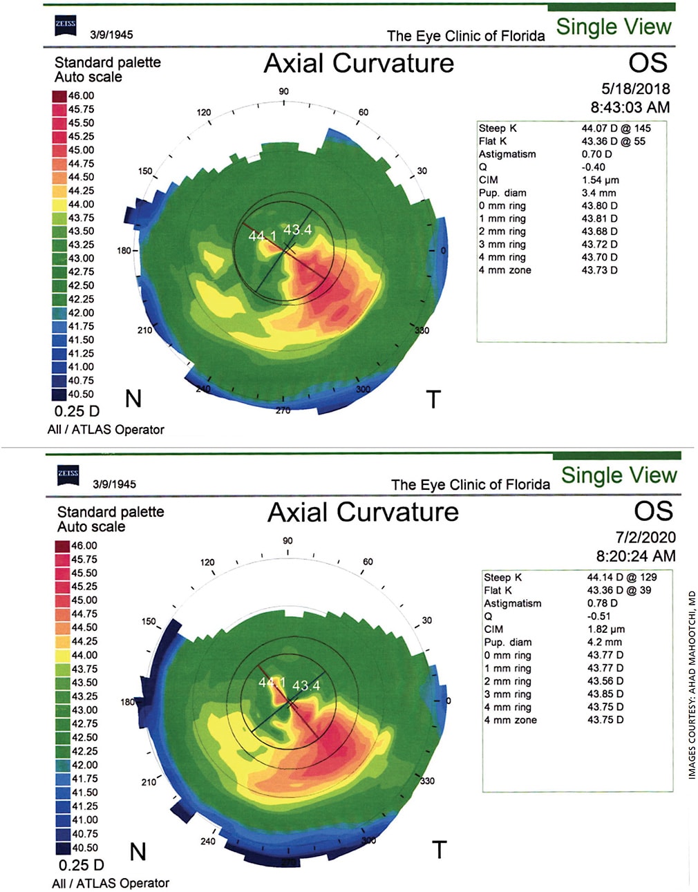 Figure. Corneal topography taken before (top) and after (bottom) implantation of the XEN Gel Stent (Allergan) shows the procedure had little effect on vision for this post-refractive patient.