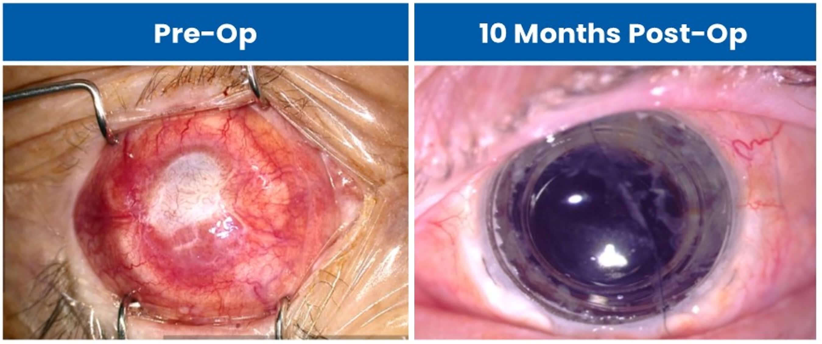 Shingles-blinded eye before and after CorNeat KPro implantation.