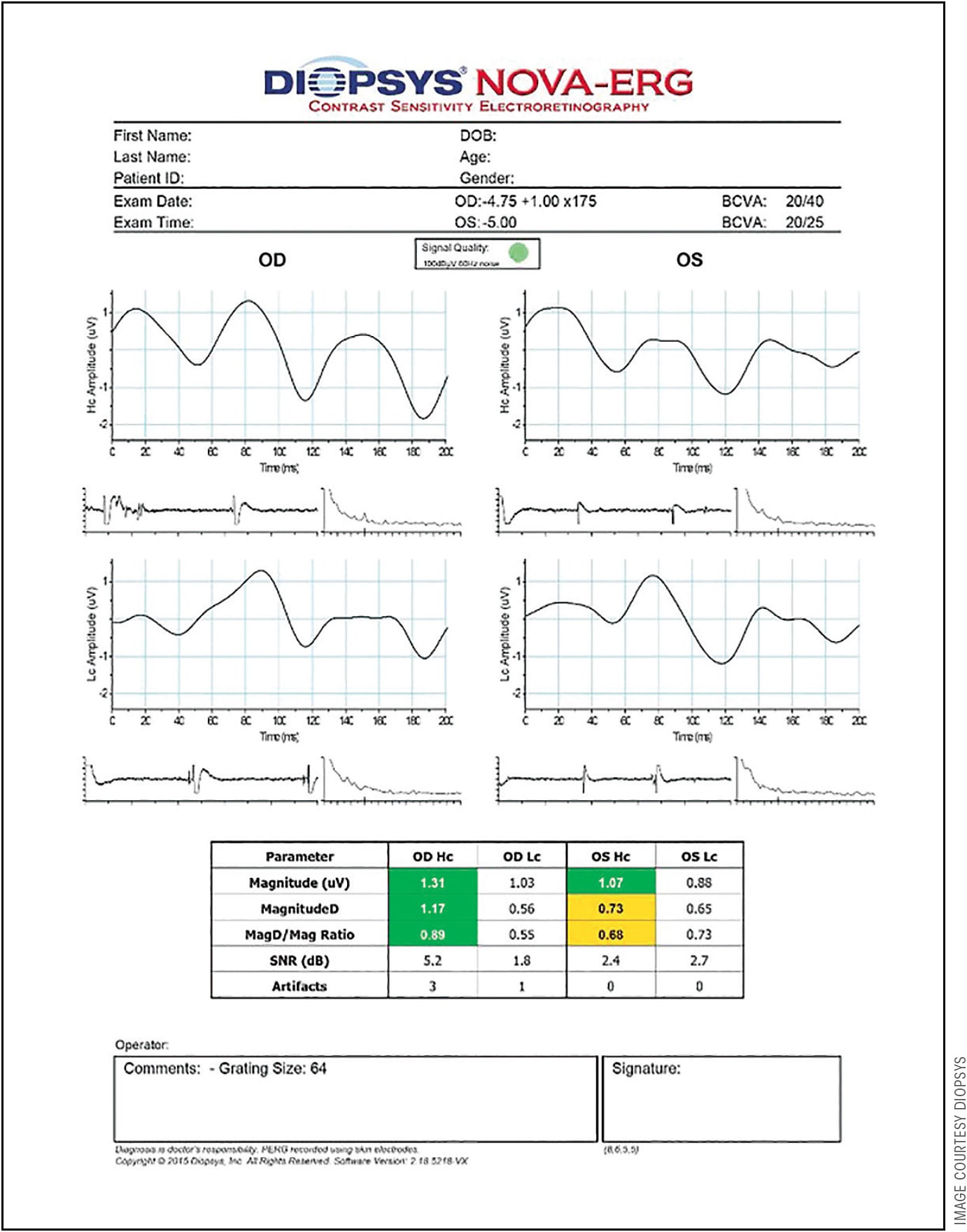 Figure 2. Electroretinography taken after SLT treatment in both eyes.