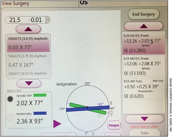 Figure 3. The ORA (Alcon) screen in a WTR patient. Notice the measurement (green) is less than the preoeprative astigmatism (blue). This is what we would expect based on Koch’s Rule and the effect the PCA has on total corneal astigmatism.