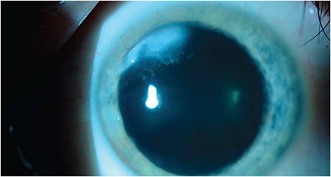 Figure 6A. A moderately sized Salzmann’s nodule is present superonasally in this left eye.