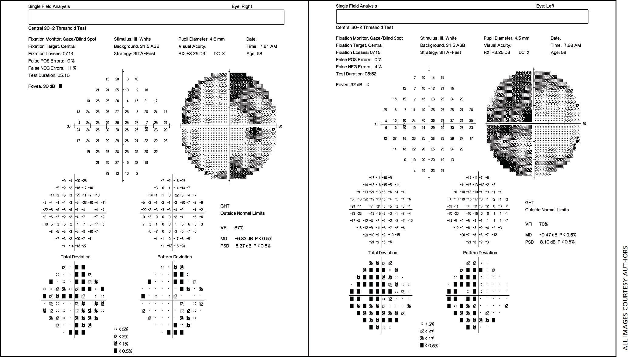 Figure 1. Humphrey Visual fields 30-2: Reliable OU. The pattern deviation demonstrates bitemporal hemianopia predominantly 
respectful of the vertical meridian.