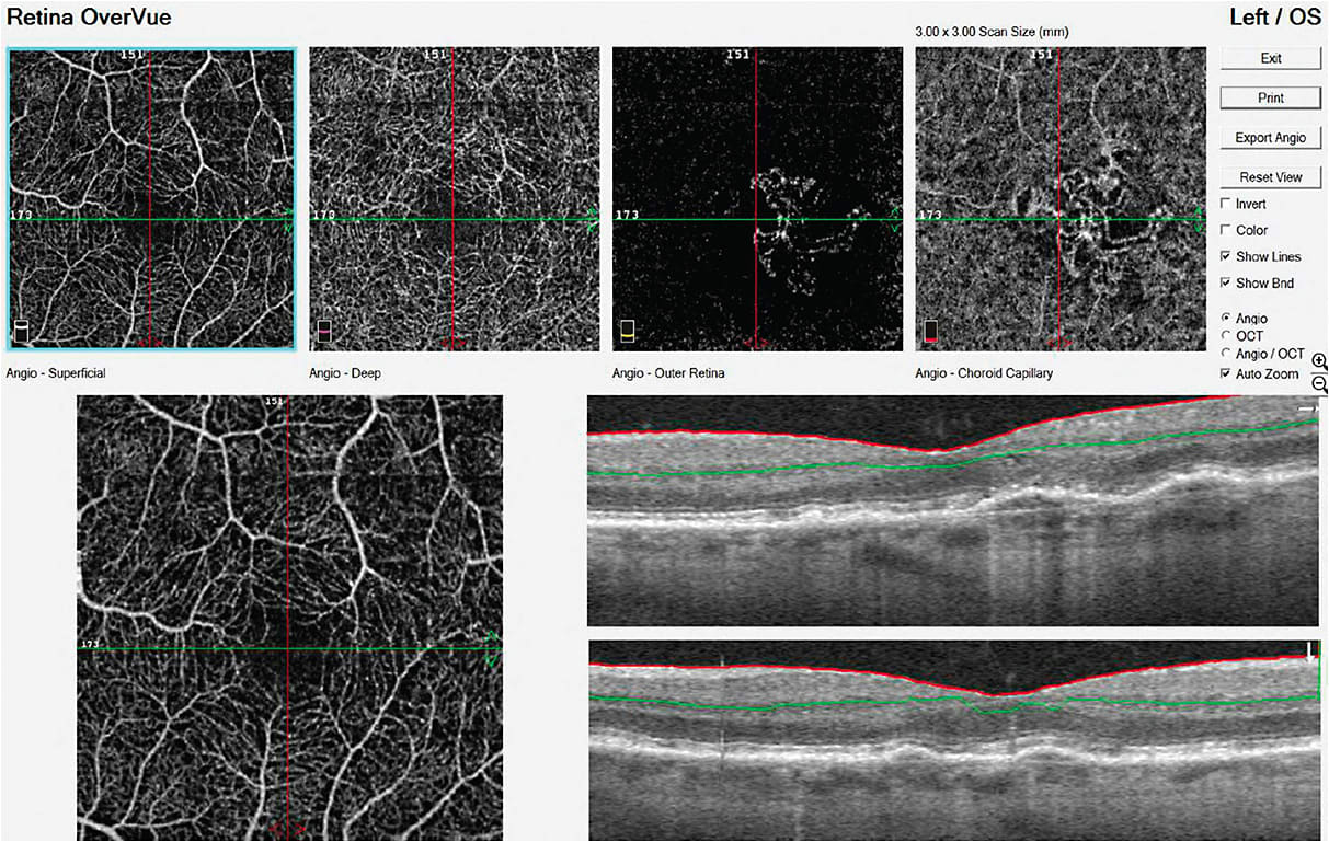 Figure 5. OCTA showing type 1 neovascularization in AMD with “medusa” pattern.