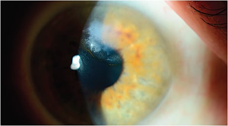 Figure 7. This right eye has a moderately large superonasal Salzmann’s nodular degeneration lesion. Note the iron line at the central edge, indicating chronicity.