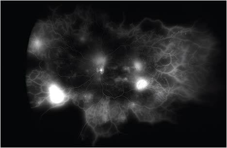 Figure 2. Ultra-widefield fluorescein angiogram (Optos) showing active neovascularization in a patient with proliferative diabetic retinopathy.