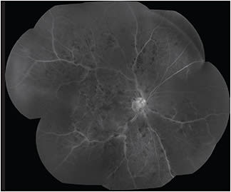Figure 7. Fluorescein angiogram in 7 standard fields showing significant nonperfusion in a patient with central retinal vein occlusion.