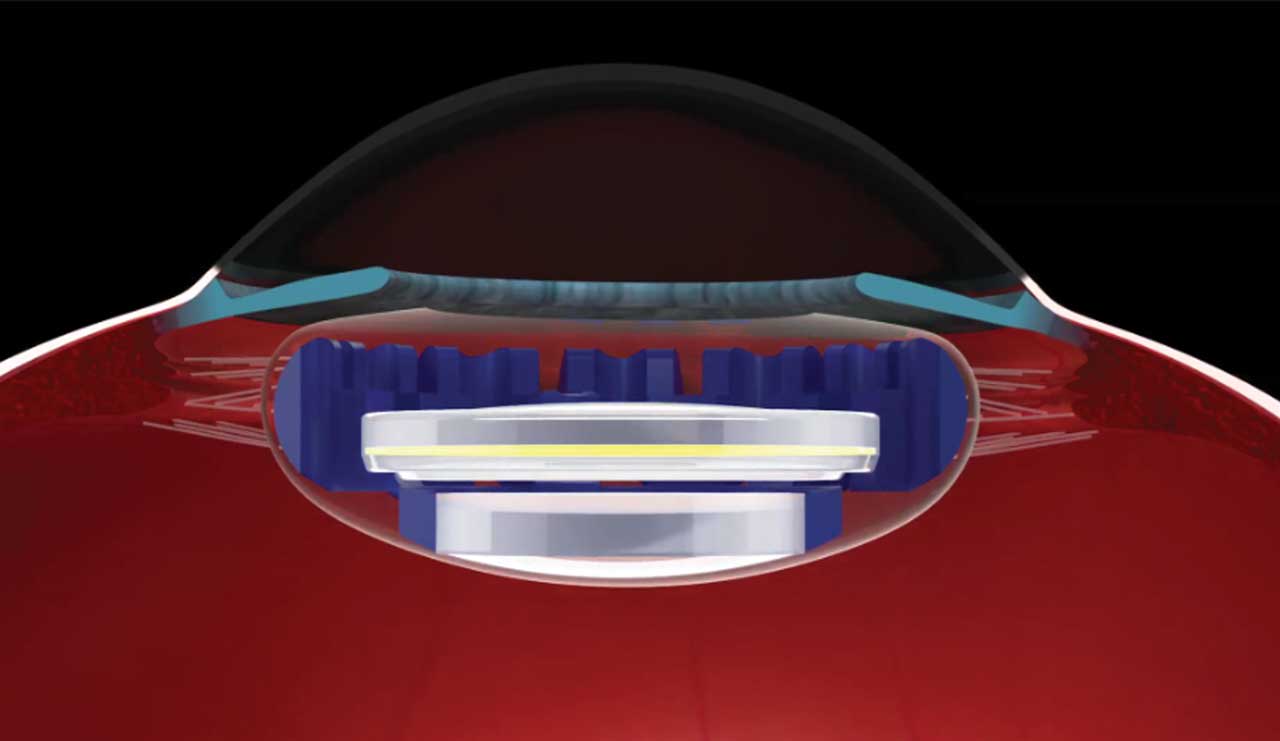 Schematic of the LensGen Juvene IOL
