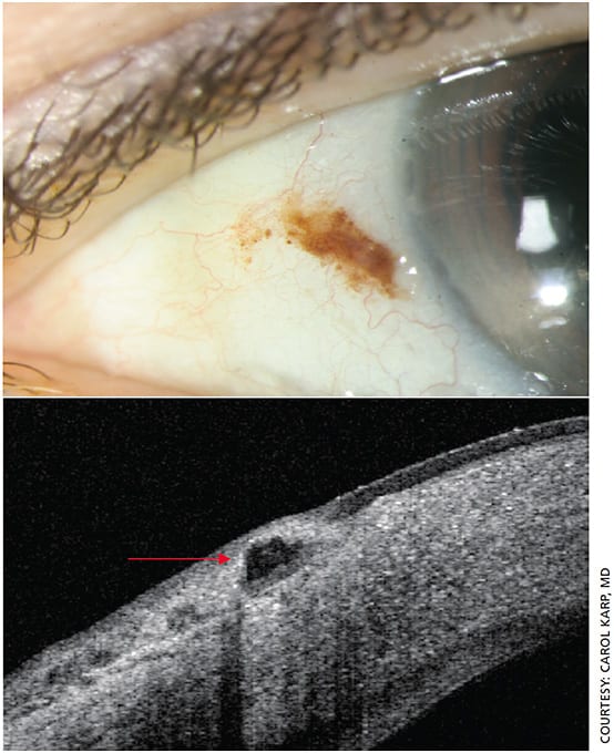 Figure 5. Slit lamp photo of conjunctival lesion and anterior segment OCT of conjunctival nevus.