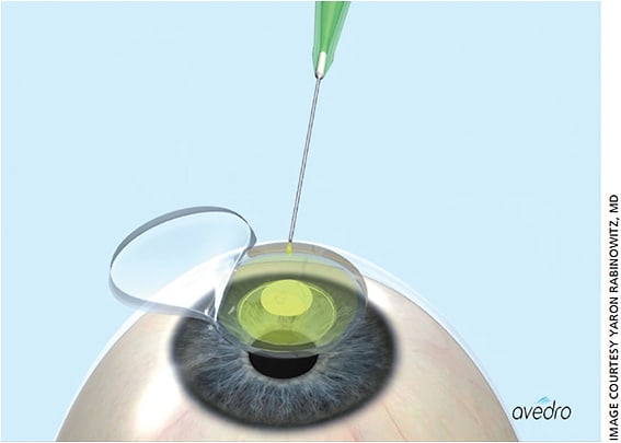 The “epi-off” method of collagen cross-linking, illustrated here, first calls for placing riboflavin on the corneal stroma.