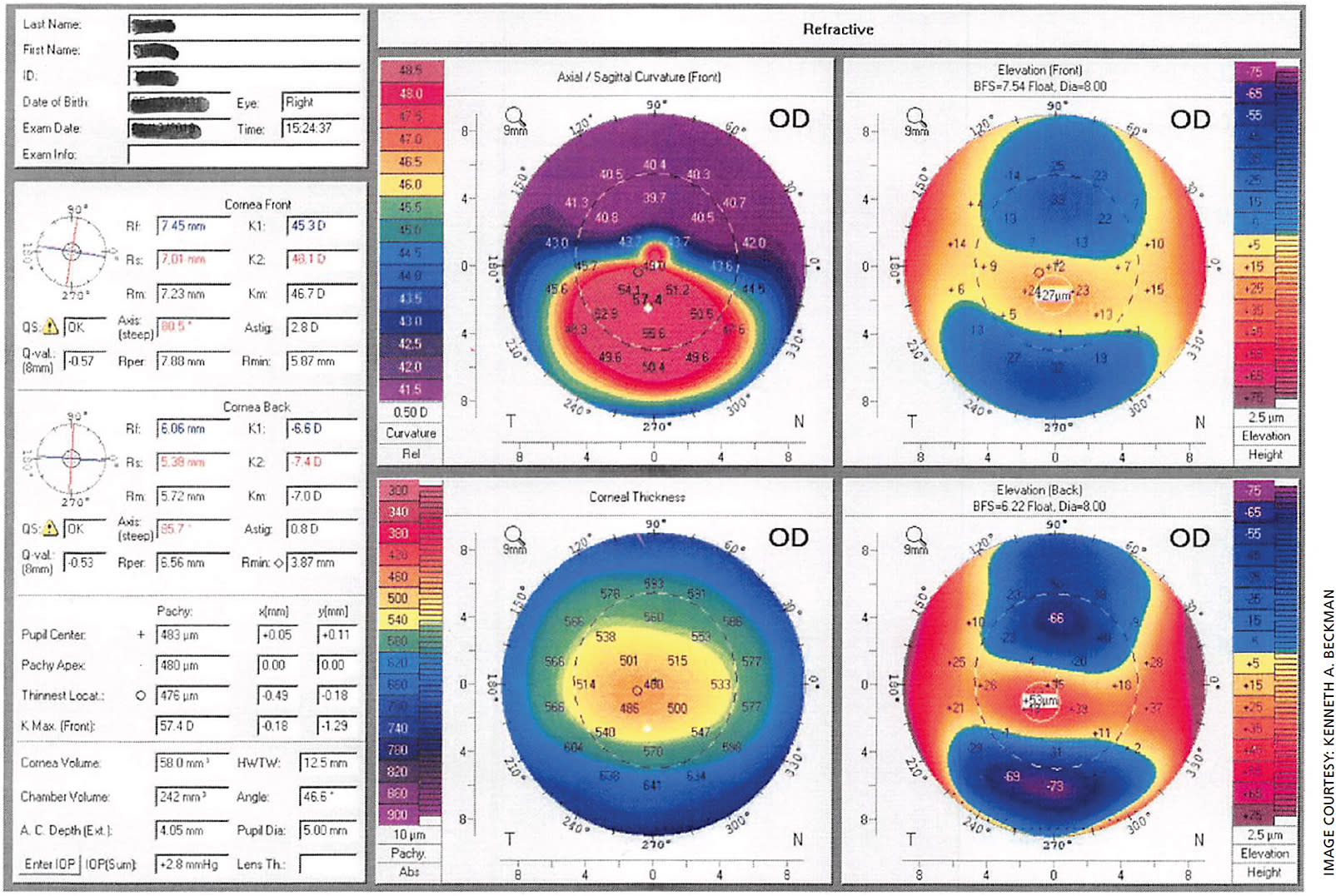 Figure. Oculus Pentacam imaging shows an obvious cone in the right eye of this 15-year-old male patient.