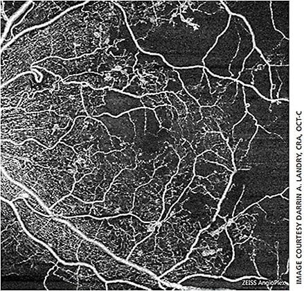 Figure 5. 8 mm x 8 mm superficial vasculature OCTA illustrating areas of presumed impaired perfusion.