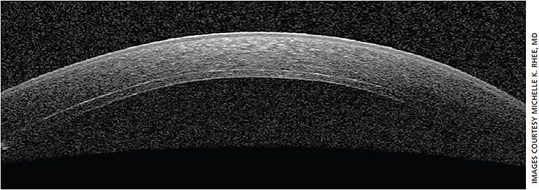 Figure 1. Postoperative OCT image of DSEK following combined CE/IOL/DSEK for a Fuchs’ dystrophy/cataract patient.