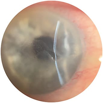 Neurotrophic keratitis Photo courtesy of Dr. Albert Cheung.