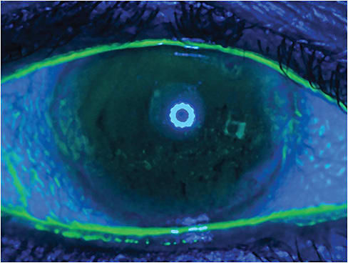 The patient backing away from the phoropter can be a sign of premature TBUT, caused by meibomian gland dysfunction, seen here.
Image courtesy of Tim Trinh, O.D.